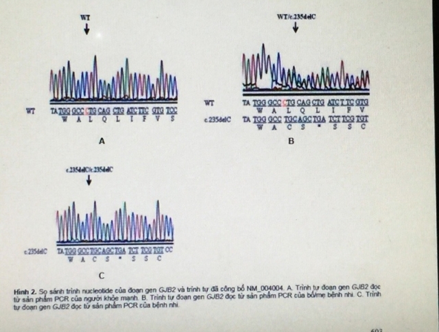 Xác định đột biến gen GJB2 ở một gia đình bệnh nhân có hai con bị khiếm thính